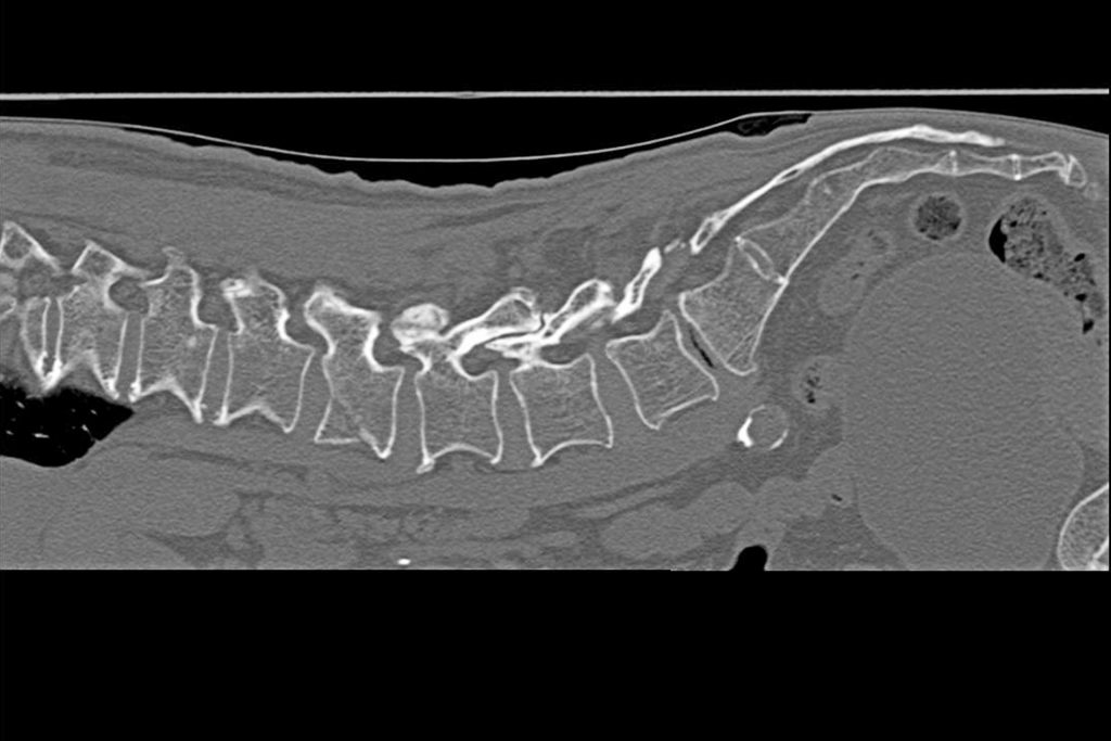 圧迫骨折のレントゲン